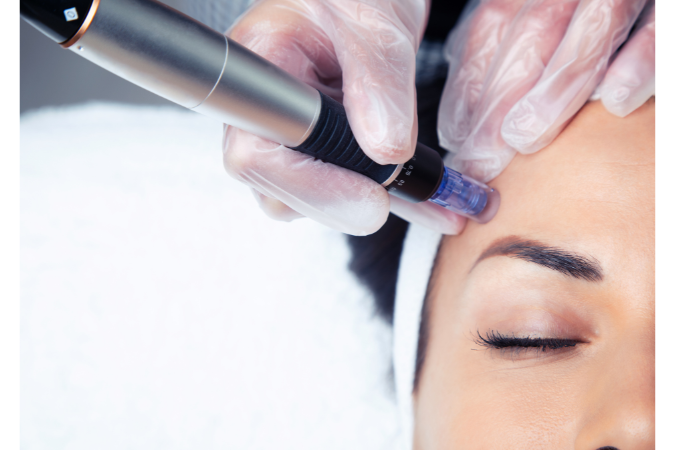 Microneedling clinic surrey